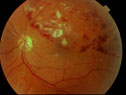 Branch Vein Occulusion