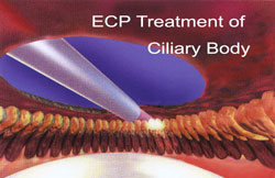 Laser surgery can reduce the need for daily medication