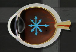 Excess fluid pressure pushes against the optic nerve